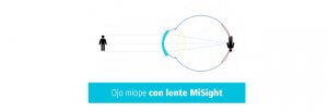 lentillas-diarias-misight-11
