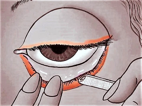 ¿Por qué aparece la blefaritis?