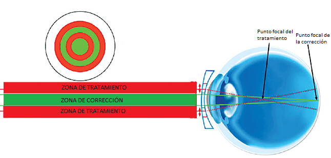 lentillas-diarias-misight-07