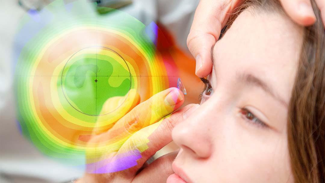 La evidencia científica en el control de miopía